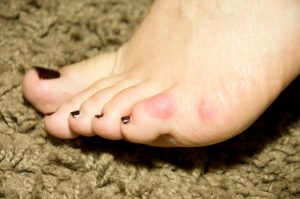 Common Foot Injury Treatment And Surgery In Mercer Island