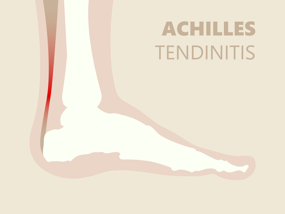 Achilles Tendonitis Treatment In Bothell