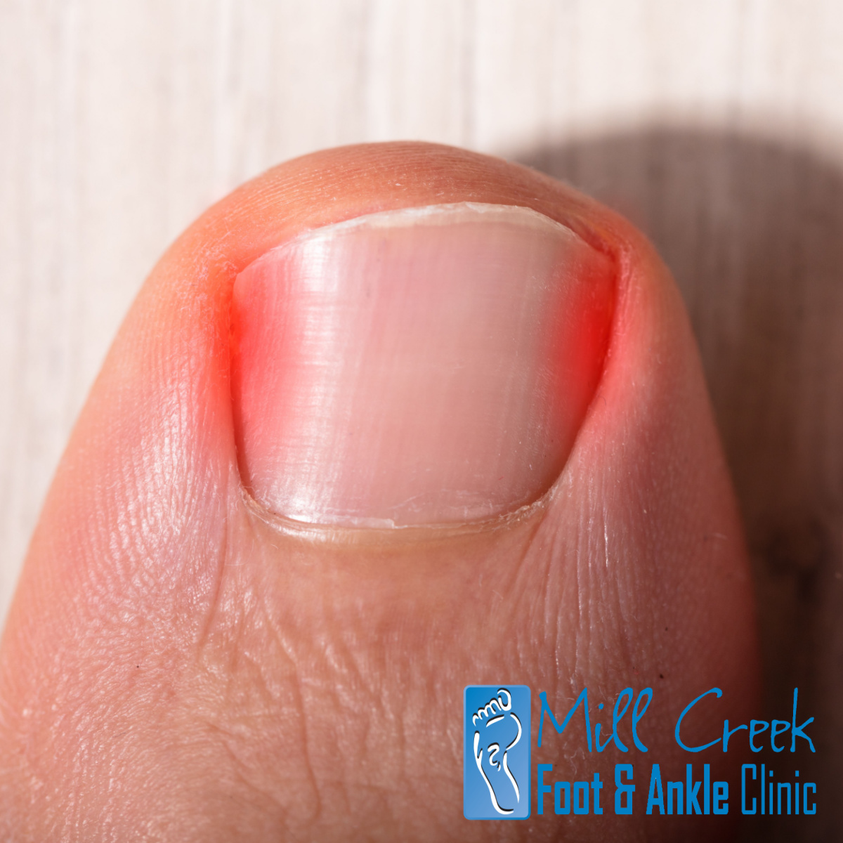 Visit A Podiatrist In The Mukilteo Area For Ingrown Toenail Treatment Or Surgery