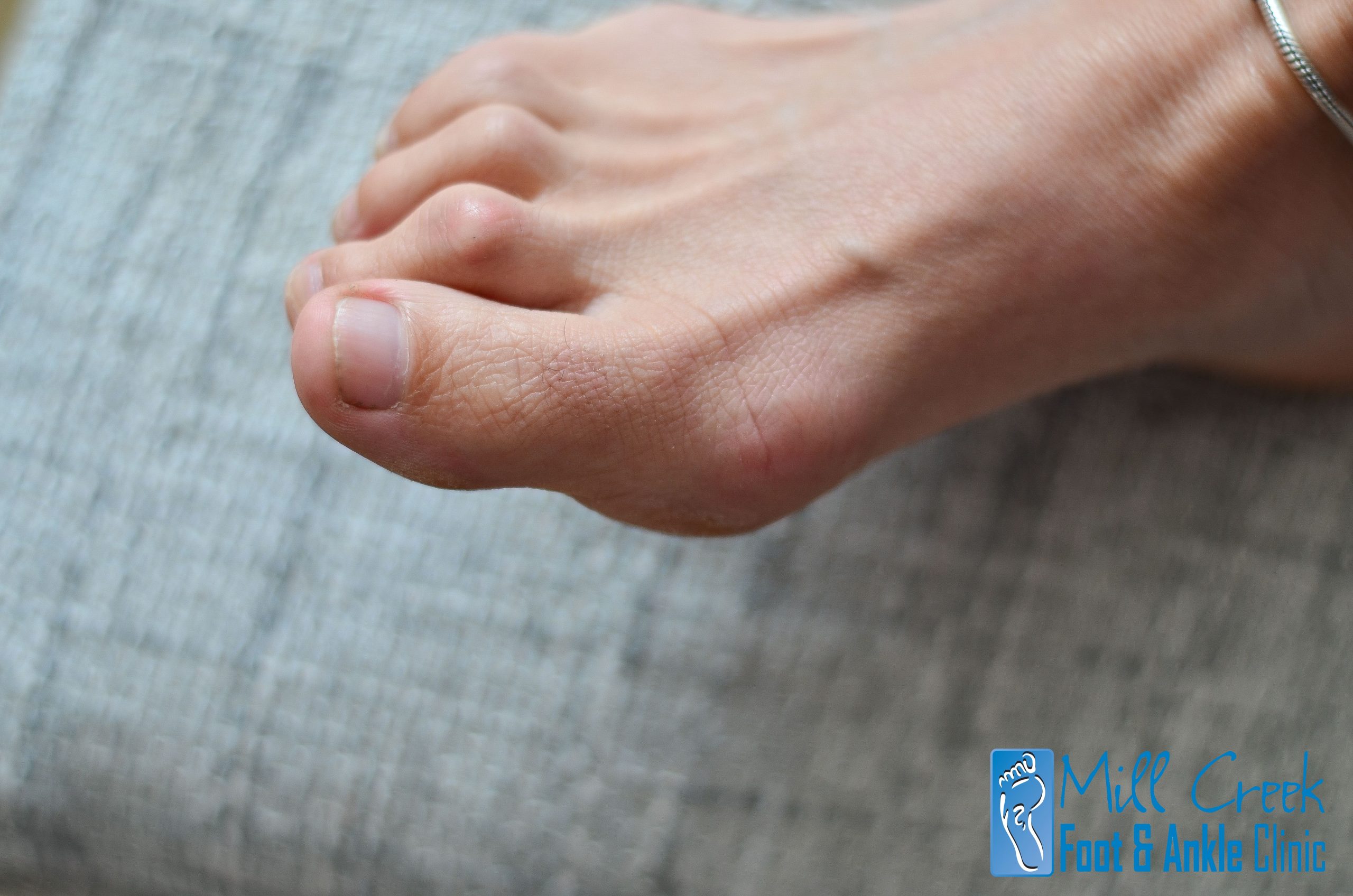 Treatment for Hammertoes - Relief at Mill Creek Foot & Ankle Clinic
